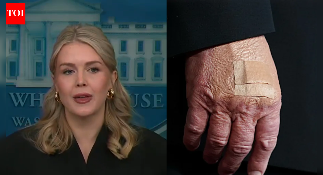 Karoline Leavitt Explains Trump’s Hand Bandages: ‘The President Is Actually…’