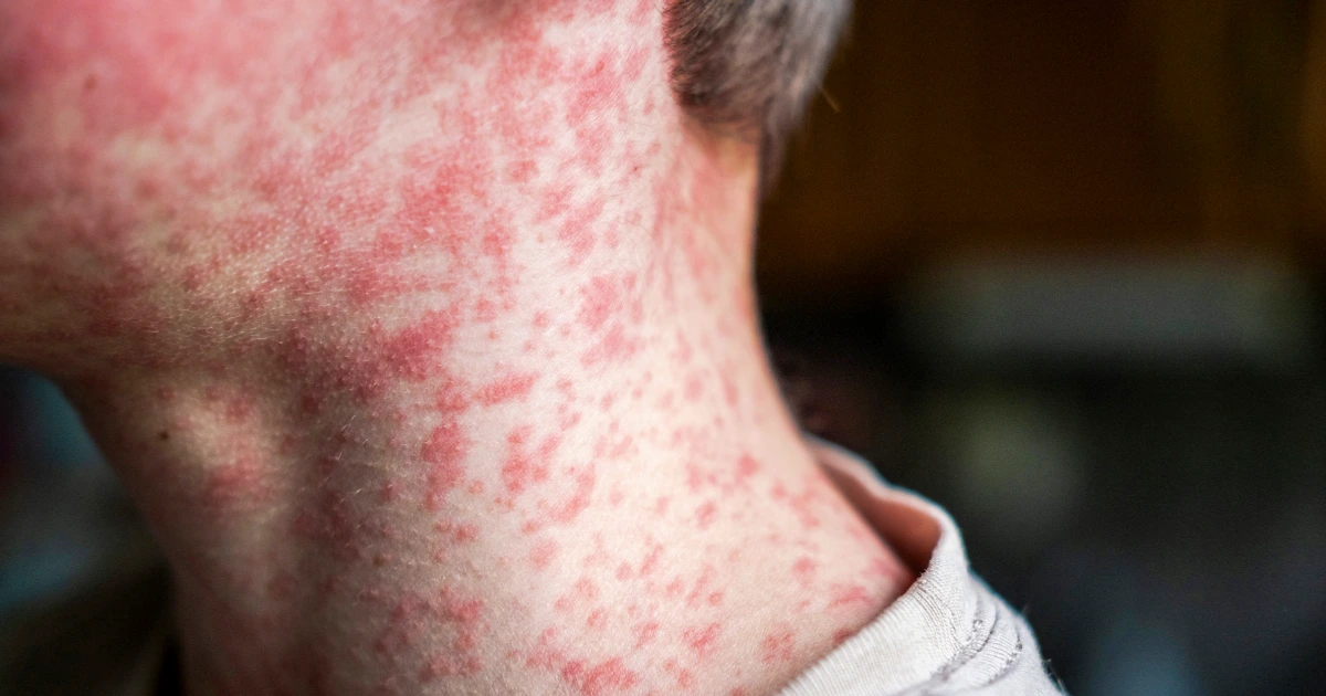 South Carolina Measles Outbreak Accelerates, Prompting Widespread Quarantine