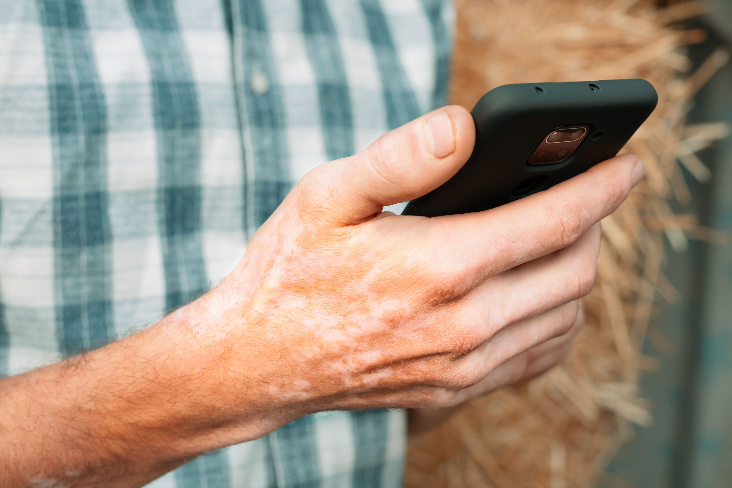 Remodeling Vitiligo Administration: The Position of AI in Affected person Care